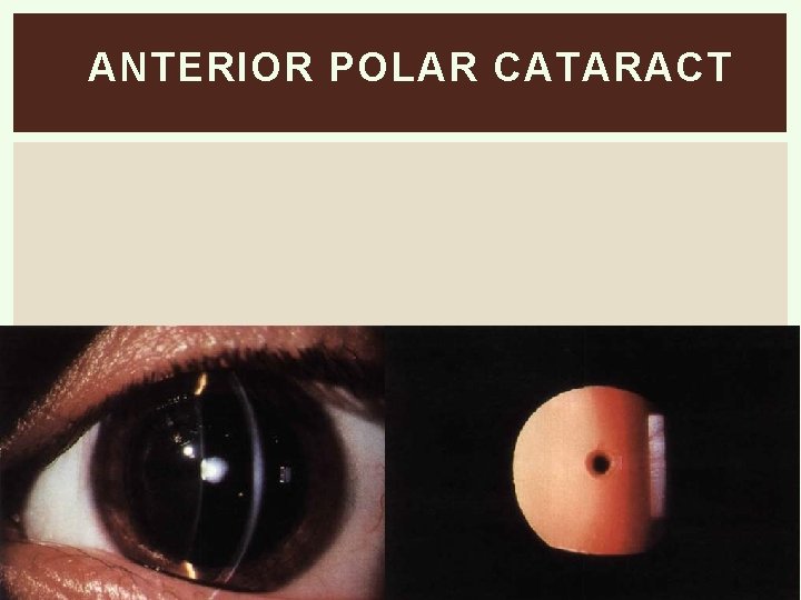 ANTERIOR POLAR CATARACT 