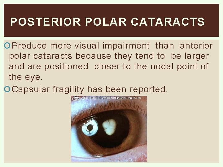 POSTERIOR POLAR CATARACTS Produce more visual impairment than anterior polar cataracts because they tend