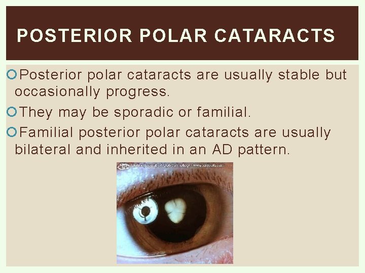 POSTERIOR POLAR CATARACTS Posterior polar cataracts are usually stable but occasionally progress. They may