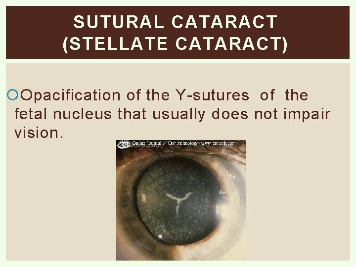 SUTURAL CATARACT (STELLATE CATARACT) Opacification of the Y-sutures of the fetal nucleus that usually