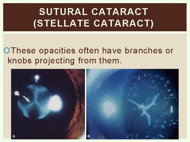 SUTURAL CATARACT (STELLATE CATARACT) These opacities often have branches or knobs projecting from them.