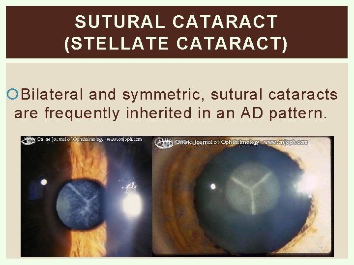 SUTURAL CATARACT (STELLATE CATARACT) Bilateral and symmetric, sutural cataracts are frequently inherited in an