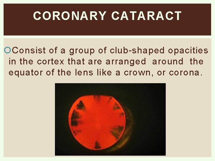 CORONARY CATARACT Consist of a group of club-shaped opacities in the cortex that are