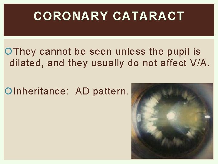 CORONARY CATARACT They cannot be seen unless the pupil is dilated, and they usually