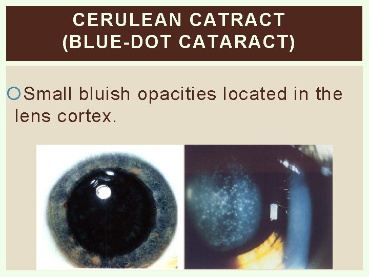 CERULEAN CATRACT (BLUE-DOT CATARACT) Small bluish opacities located in the lens cortex. 