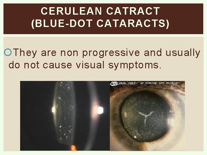 CERULEAN CATRACT (BLUE-DOT CATARACTS) They are non progressive and usually do not cause visual