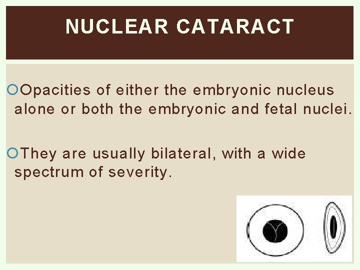 NUCLEAR CATARACT Opacities of either the embryonic nucleus alone or both the embryonic and