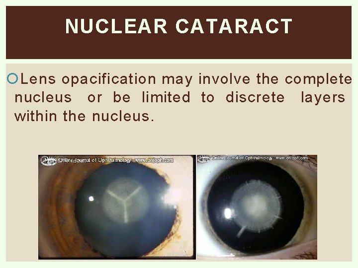 NUCLEAR CATARACT Lens opacification may involve the complete nucleus or be limited to discrete