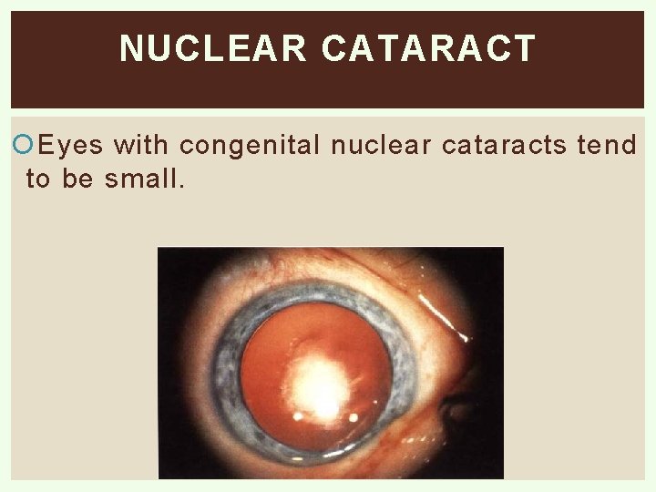 NUCLEAR CATARACT Eyes with congenital nuclear cataracts tend to be small. 