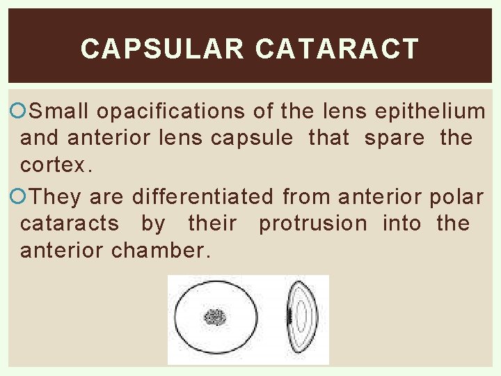 CAPSULAR CATARACT Small opacifications of the lens epithelium and anterior lens capsule that spare