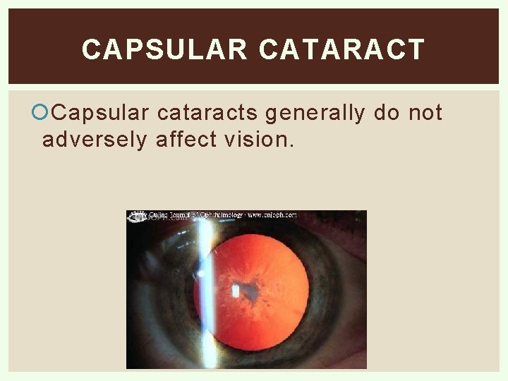 CAPSULAR CATARACT Capsular cataracts generally do not adversely affect vision. 