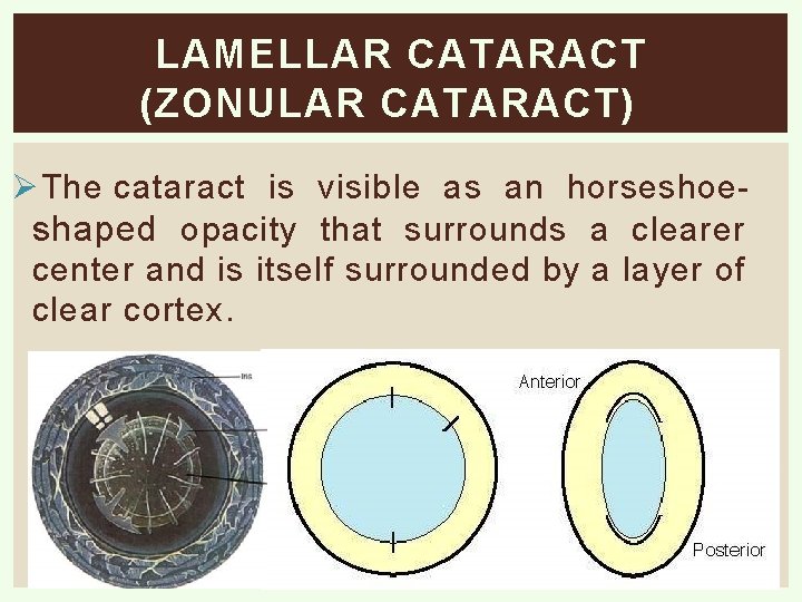 LAMELLAR CATARACT (ZONULAR CATARACT) Ø The cataract is visible as an horseshoeshaped opacity that