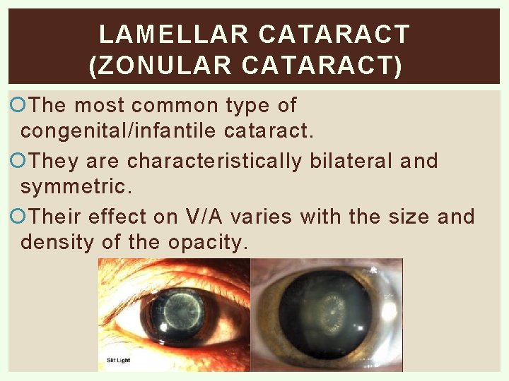 LAMELLAR CATARACT (ZONULAR CATARACT) The most common type of congenital/infantile cataract. They are characteristically