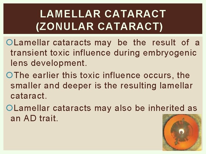 LAMELLAR CATARACT (ZONULAR CATARACT) Lamellar cataracts may be the result of a transient toxic