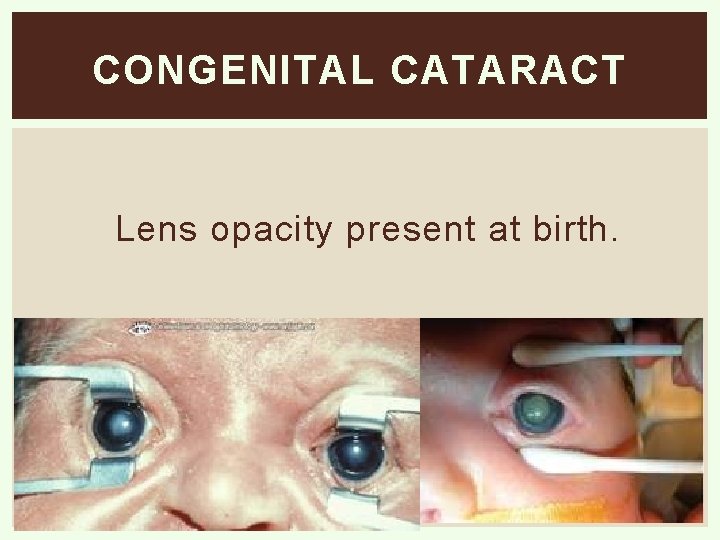 CONGENITAL CATARACT Lens opacity present at birth. 