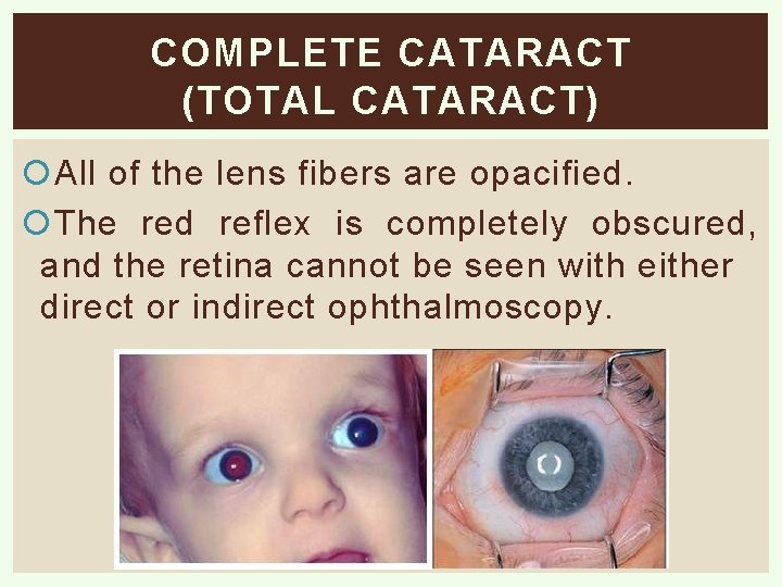 COMPLETE CATARACT (TOTAL CATARACT) All of the lens fibers are opacified. The red reflex