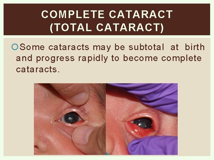 COMPLETE CATARACT (TOTAL CATARACT) Some cataracts may be subtotal at birth and progress rapidly