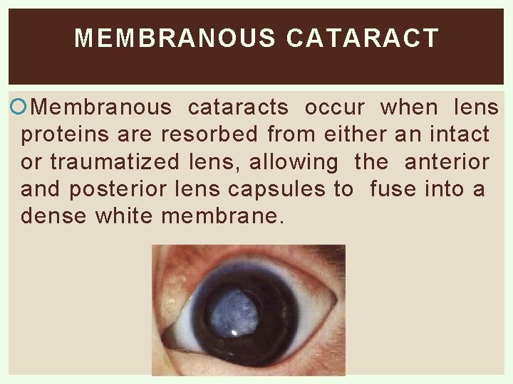 MEMBRANOUS CATARACT Membranous cataracts occur when lens proteins are resorbed from either an intact