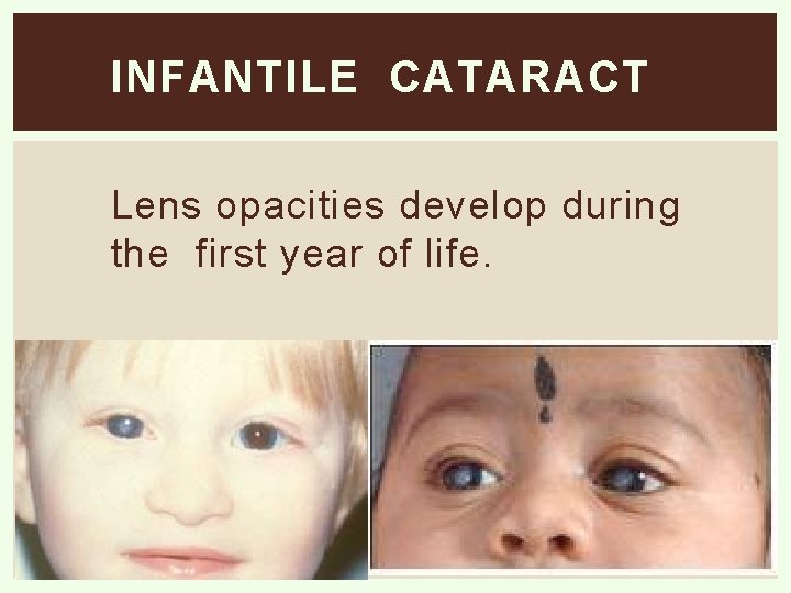 INFANTILE CATARACT Lens opacities develop during the first year of life. 