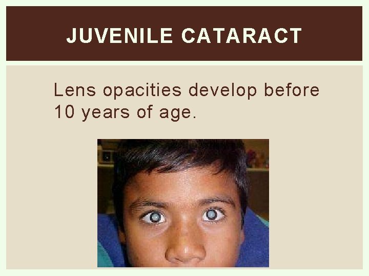 JUVENILE CATARACT Lens opacities develop before 10 years of age. 