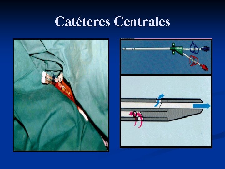 Catéteres Centrales 