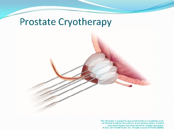 Prostate Cryotherapy This information is provided for general information on Cryoablation and is not Prostate Cryotherapy This information is provided for general information on Cryoablation and is not