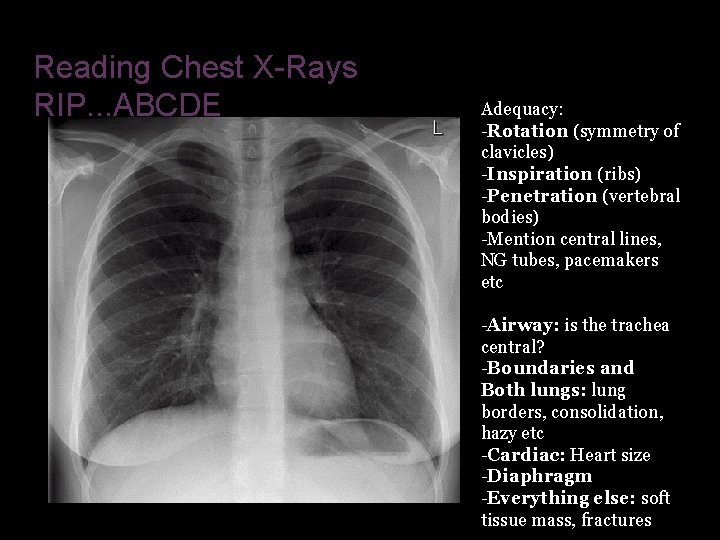 Reading Chest X-Rays RIP. . . ABCDE Adequacy: -Rotation (symmetry of clavicles) -Inspiration (ribs)
