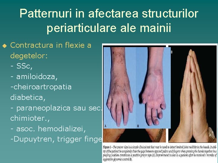 Patternuri in afectarea structurilor periarticulare ale mainii u Contractura in flexie a degetelor: -