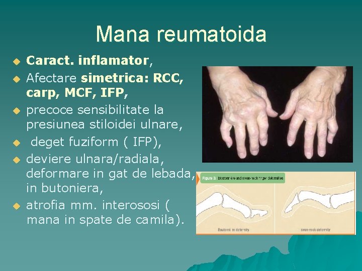 Mana reumatoida u u u Caract. inflamator, Afectare simetrica: RCC, carp, MCF, IFP, precoce