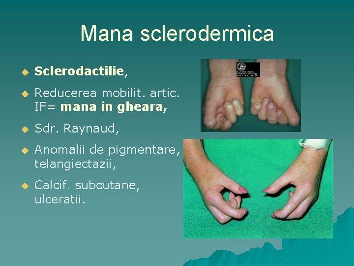 Mana sclerodermica u Sclerodactilie, u Reducerea mobilit. artic. IF= mana in gheara, u Sdr.