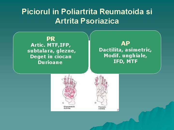 Piciorul in Poliartrita Reumatoida si Artrita Psoriazica PR Artic. MTF, IFP, subtalara, glezne, Deget