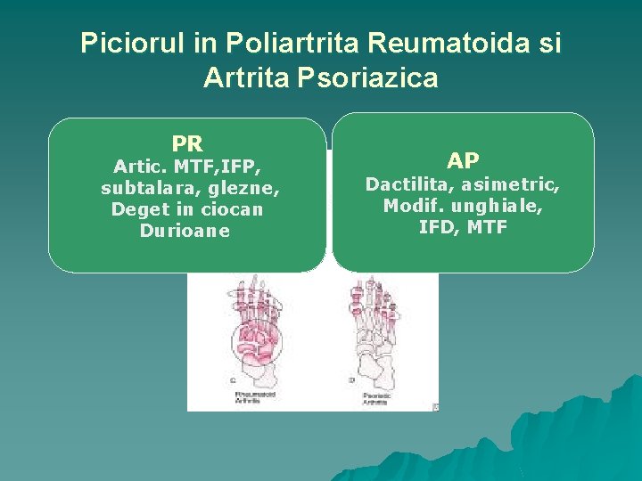 artrita sternoclaviculara dureri la nivelul genunchiului în timp ce alergați