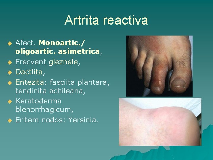 artrita reactiva bacteriana)