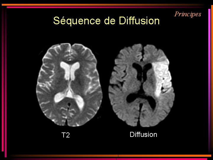 Séquence de Diffusion T 2 Diffusion Principes Séquence de Diffusion T 2 Diffusion Principes
