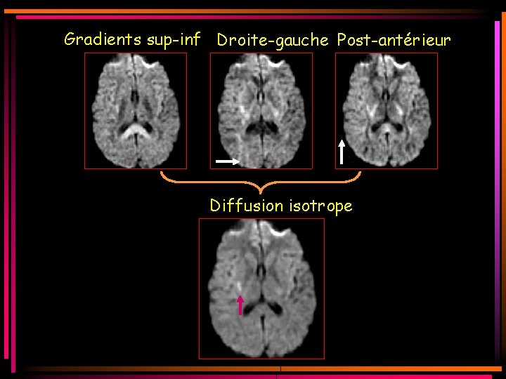 Gradients sup-inf Droite-gauche Post-antérieur Diffusion isotrope Gradients sup-inf Droite-gauche Post-antérieur Diffusion isotrope