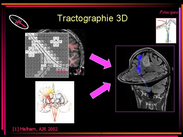 Tractographie 3 D [1] Melhem, AJR 2002 [1] Principes 