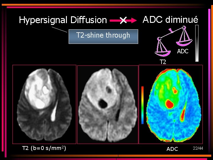 Hypersignal Diffusion ADC diminué T 2 -shine through ADC T 2 (b=0 s/mm 2) Hypersignal Diffusion ADC diminué T 2 -shine through ADC T 2 (b=0 s/mm 2)