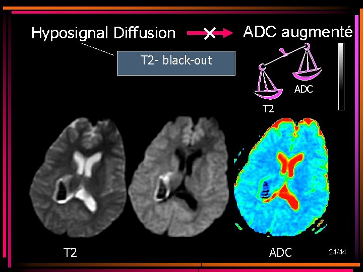 Hyposignal Diffusion ADC augmenté T 2 - black-out ADC T 2 ADC 24/44 Hyposignal Diffusion ADC augmenté T 2 - black-out ADC T 2 ADC 24/44