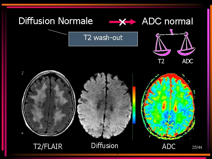 Diffusion Normale ADC normal T 2 wash-out T 2/FLAIR Diffusion ADC 25/44 Diffusion Normale ADC normal T 2 wash-out T 2/FLAIR Diffusion ADC 25/44