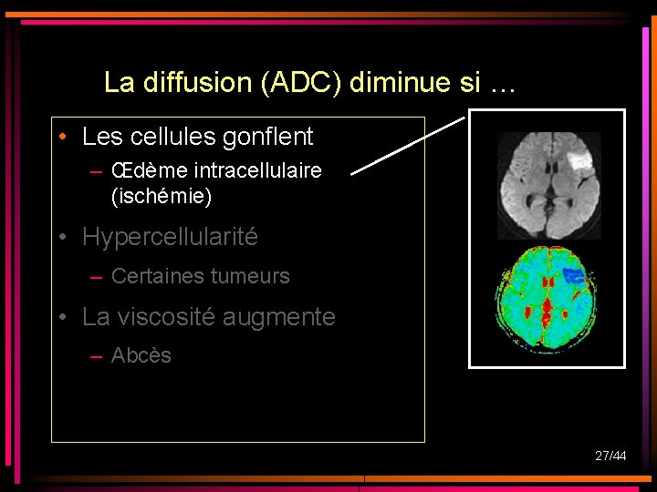 La diffusion (ADC) diminue si … • Les cellules gonflent – Œdème intracellulaire (ischémie) La diffusion (ADC) diminue si … • Les cellules gonflent – Œdème intracellulaire (ischémie)