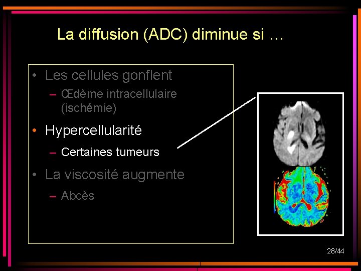 La diffusion (ADC) diminue si … • Les cellules gonflent – Œdème intracellulaire (ischémie) La diffusion (ADC) diminue si … • Les cellules gonflent – Œdème intracellulaire (ischémie)