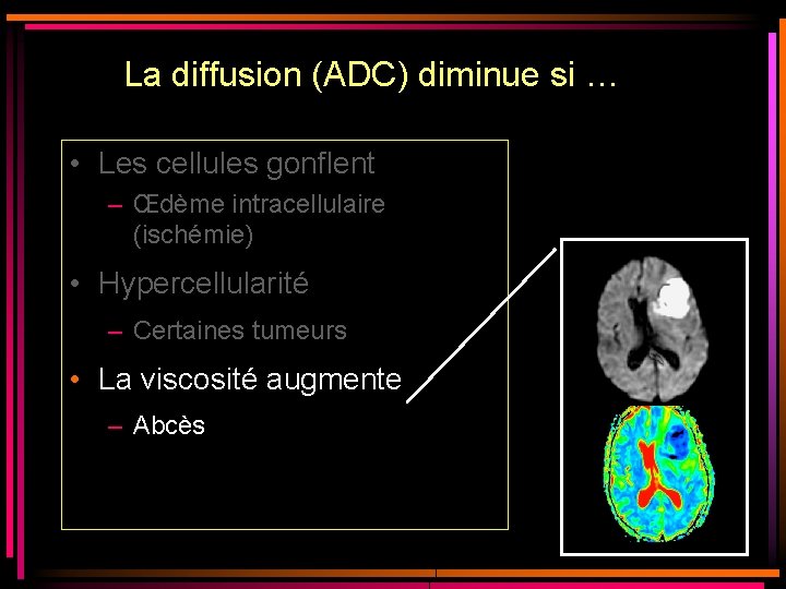 La diffusion (ADC) diminue si … • Les cellules gonflent – Œdème intracellulaire (ischémie) La diffusion (ADC) diminue si … • Les cellules gonflent – Œdème intracellulaire (ischémie)