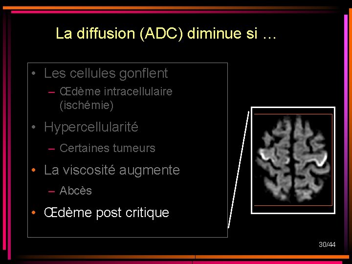 La diffusion (ADC) diminue si … • Les cellules gonflent – Œdème intracellulaire (ischémie) La diffusion (ADC) diminue si … • Les cellules gonflent – Œdème intracellulaire (ischémie)