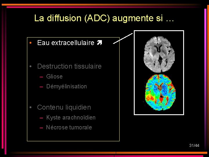 La diffusion (ADC) augmente si … • Eau extracellulaire • Destruction tissulaire – Gliose La diffusion (ADC) augmente si … • Eau extracellulaire • Destruction tissulaire – Gliose