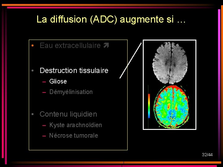 La diffusion (ADC) augmente si … • Eau extracellulaire • Destruction tissulaire – Gliose La diffusion (ADC) augmente si … • Eau extracellulaire • Destruction tissulaire – Gliose