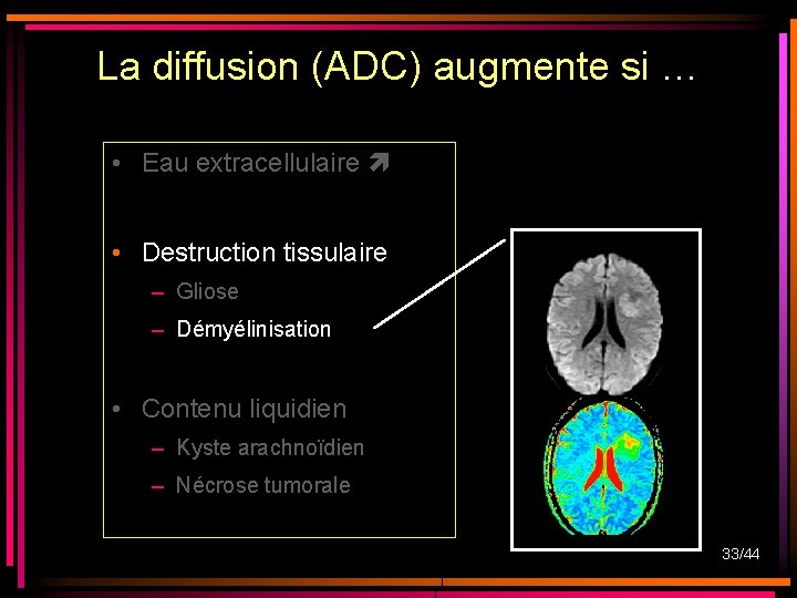 La diffusion (ADC) augmente si … • Eau extracellulaire • Destruction tissulaire – Gliose La diffusion (ADC) augmente si … • Eau extracellulaire • Destruction tissulaire – Gliose