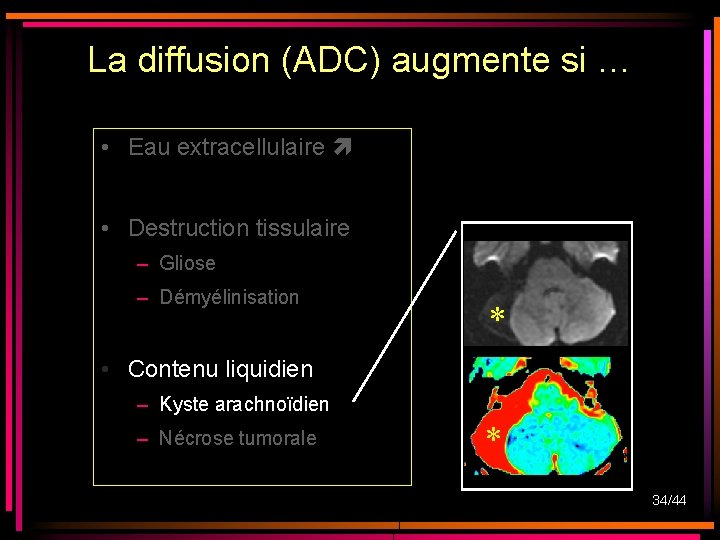La diffusion (ADC) augmente si … • Eau extracellulaire • Destruction tissulaire – Gliose La diffusion (ADC) augmente si … • Eau extracellulaire • Destruction tissulaire – Gliose
