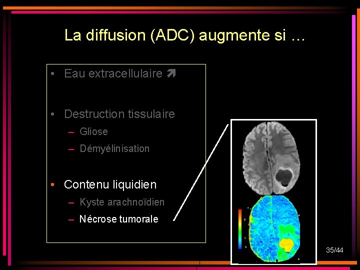 La diffusion (ADC) augmente si … • Eau extracellulaire • Destruction tissulaire – Gliose La diffusion (ADC) augmente si … • Eau extracellulaire • Destruction tissulaire – Gliose