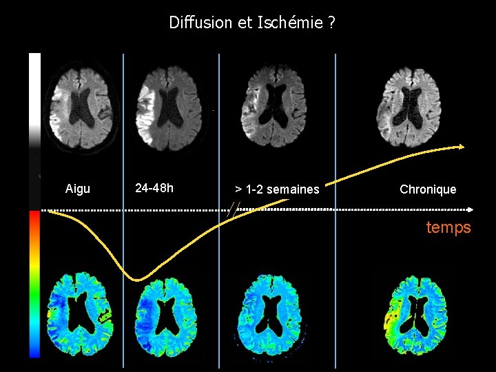 Diffusion et Ischémie ? Aigu 24 -48 h > 1 -2 semaines Chronique temps Diffusion et Ischémie ? Aigu 24 -48 h > 1 -2 semaines Chronique temps