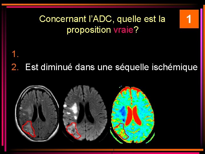 Concernant l’ADC, quelle est la proposition vraie? 1 1. 2. Est diminué dans une Concernant l’ADC, quelle est la proposition vraie? 1 1. 2. Est diminué dans une